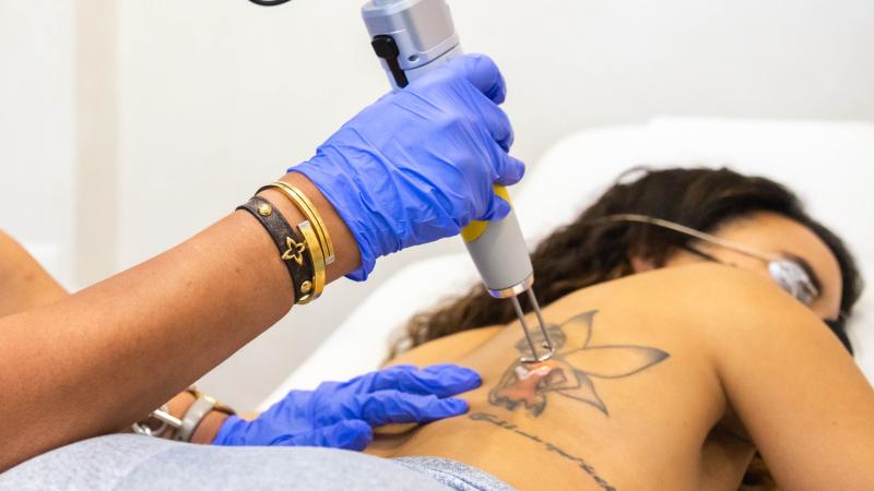 Laser Détatouage Hollywood Spectra - Dr Baron